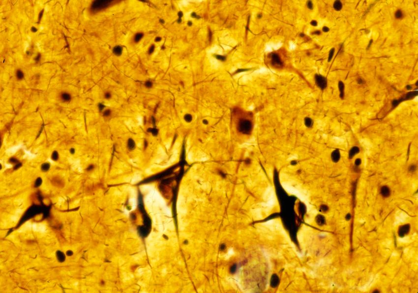 Light microscopy micrograph of human cerebral cortex neurons showing dense neurofibrillary tangle content that is characteristic of neuropathology and frequently seen in the tauopathies. Light microscopy micrograph of human cerebral cortex neurons showing dense neurofibrillary tangle content that is characteristic of neuropathology and frequently seen in the tauopathies.
